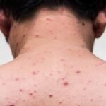 Setelah Afrika, Cacar Monyet Dikhawatirkan Menyebar ke Amerika Latin